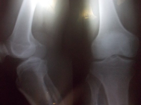 X-Ray Of My Right Knee