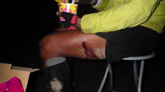 Eating My Hot Noodles With The Picture Of A Leech Bite