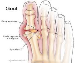 Very Accurate Depiction Of My Gout (Picture Taken From Google